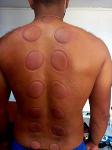cupping-therapy-at-wellnest-1