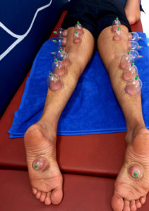 cupping-therapy-at-wellnest