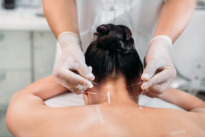 dry-needle-therapy
