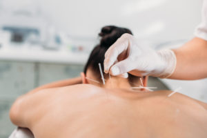 dry-needle-therapy-wellnest