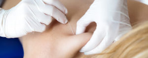 dry needling 2