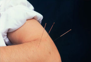 dry-needling-tennis-elbow