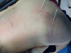 dry-needling-wellnest-2