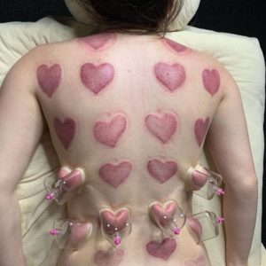 heart shaped cupping